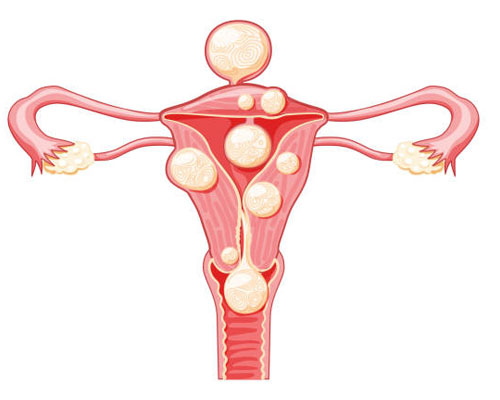 Myomların Anatomik Görünümleri