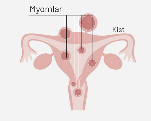 Myomlar nerelerde olur